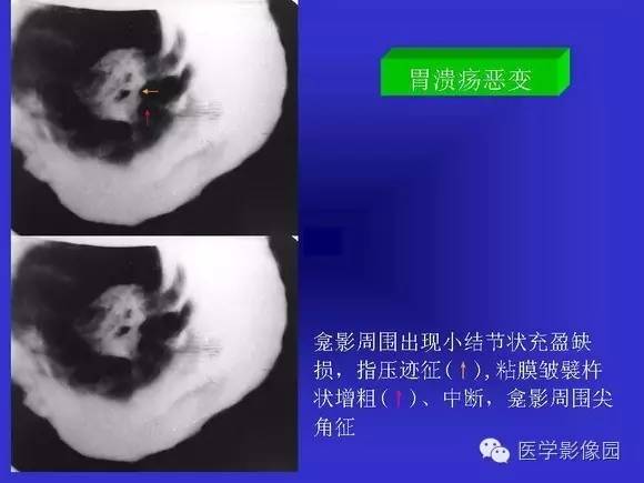 【PPT】上消化道溃疡与胃癌的影像学表现