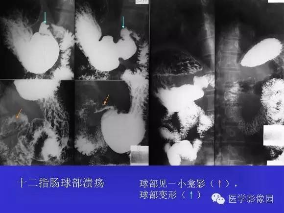 【PPT】上消化道溃疡与胃癌的影像学表现