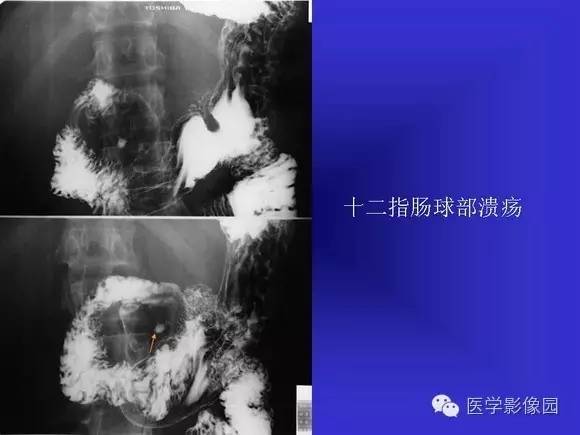 【PPT】上消化道溃疡与胃癌的影像学表现