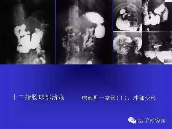【PPT】上消化道溃疡与胃癌的影像学表现
