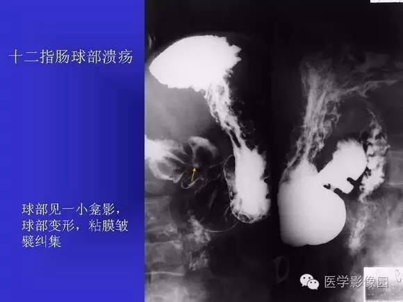 【PPT】上消化道溃疡与胃癌的影像学表现