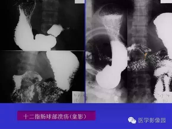 【PPT】上消化道溃疡与胃癌的影像学表现