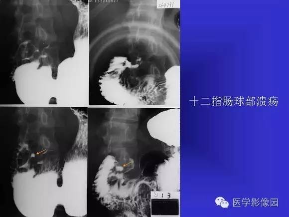 【PPT】上消化道溃疡与胃癌的影像学表现