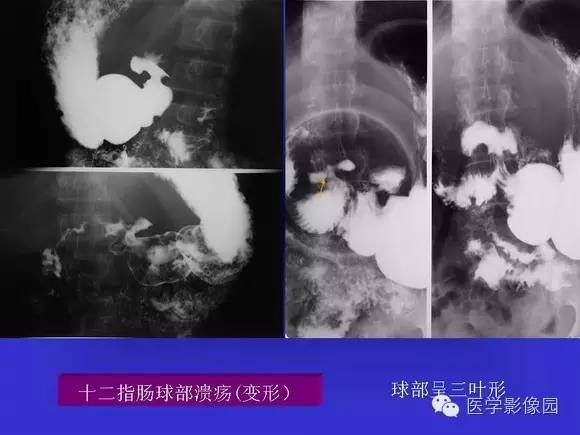 【PPT】上消化道溃疡与胃癌的影像学表现