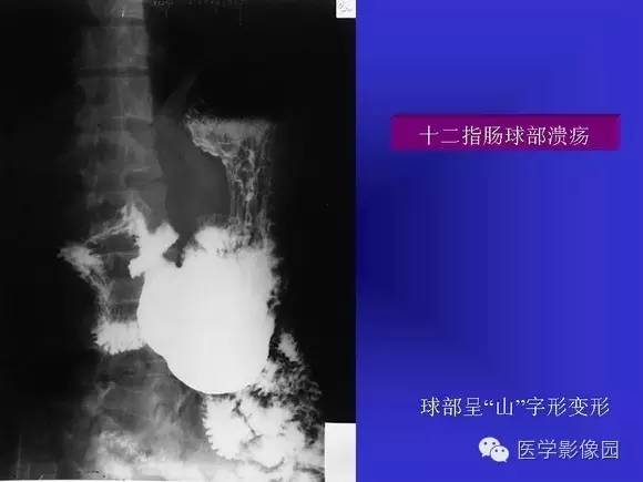 【PPT】上消化道溃疡与胃癌的影像学表现