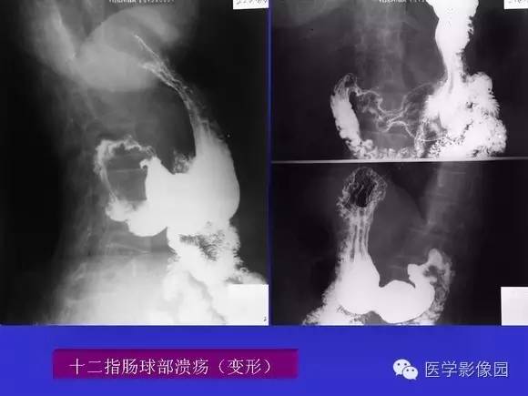【PPT】上消化道溃疡与胃癌的影像学表现