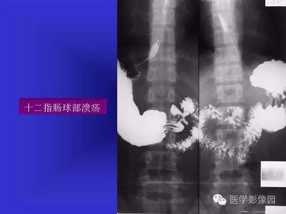 【PPT】上消化道溃疡与胃癌的影像学表现