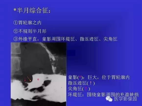 【PPT】上消化道溃疡与胃癌的影像学表现