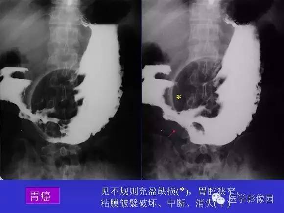 【PPT】上消化道溃疡与胃癌的影像学表现