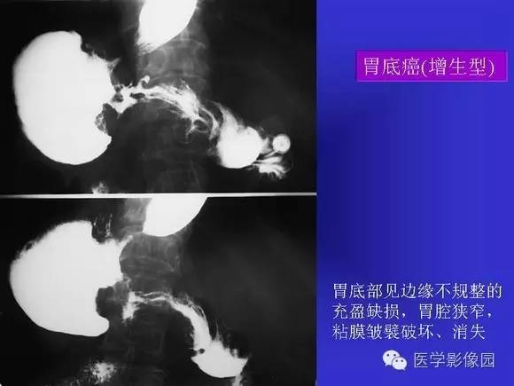 【PPT】上消化道溃疡与胃癌的影像学表现