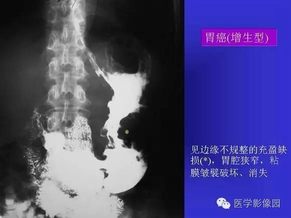 【PPT】上消化道溃疡与胃癌的影像学表现