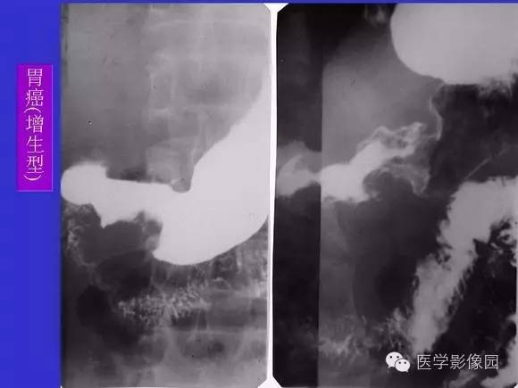 【PPT】上消化道溃疡与胃癌的影像学表现