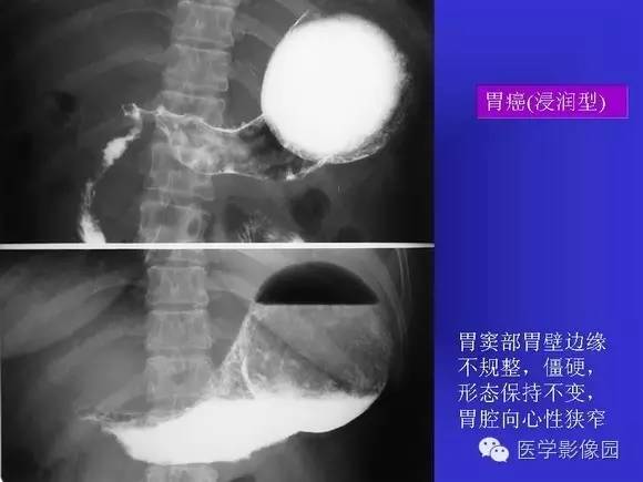 【PPT】上消化道溃疡与胃癌的影像学表现
