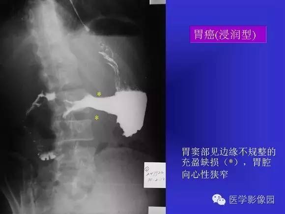 【PPT】上消化道溃疡与胃癌的影像学表现