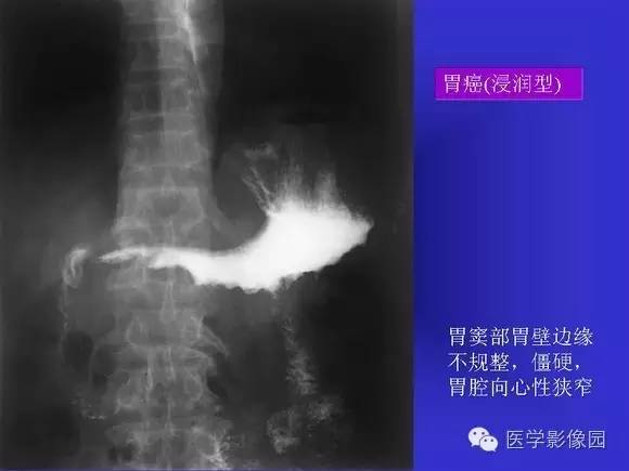 【PPT】上消化道溃疡与胃癌的影像学表现