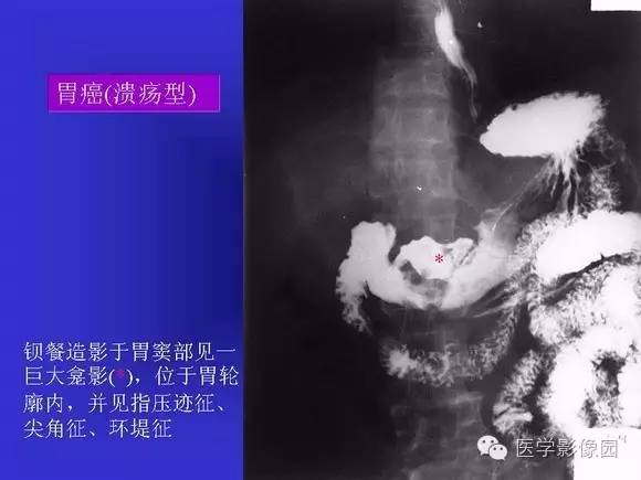 【PPT】上消化道溃疡与胃癌的影像学表现