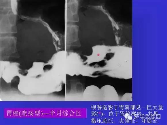 【PPT】上消化道溃疡与胃癌的影像学表现