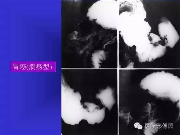 【PPT】上消化道溃疡与胃癌的影像学表现