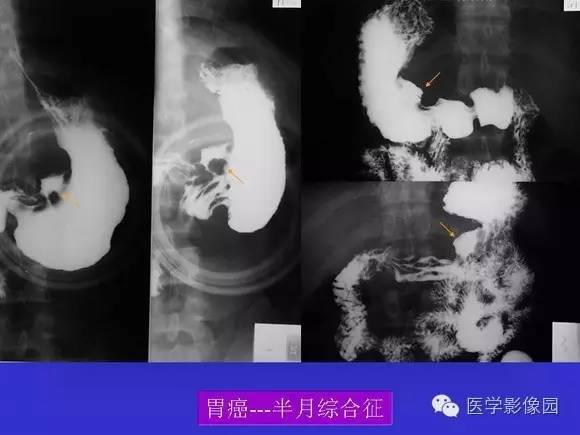 【PPT】上消化道溃疡与胃癌的影像学表现