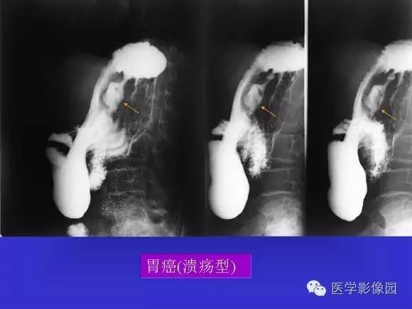 【PPT】上消化道溃疡与胃癌的影像学表现