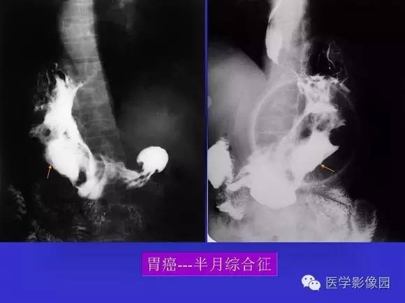 【PPT】上消化道溃疡与胃癌的影像学表现