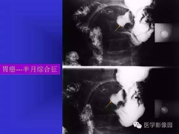 【PPT】上消化道溃疡与胃癌的影像学表现