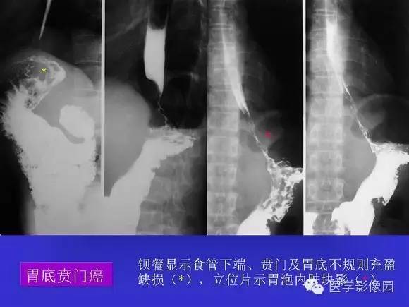 【PPT】上消化道溃疡与胃癌的影像学表现