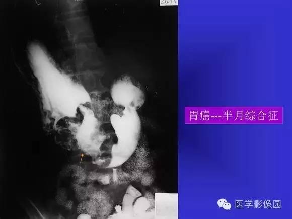 【PPT】上消化道溃疡与胃癌的影像学表现