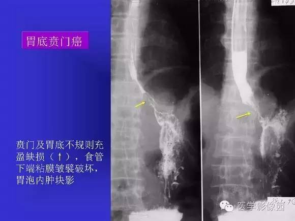 【PPT】上消化道溃疡与胃癌的影像学表现