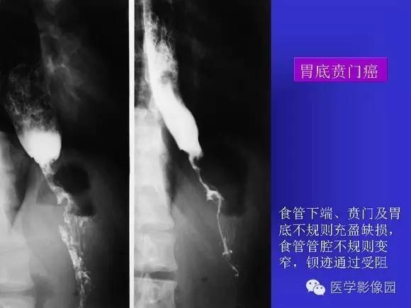 【PPT】上消化道溃疡与胃癌的影像学表现