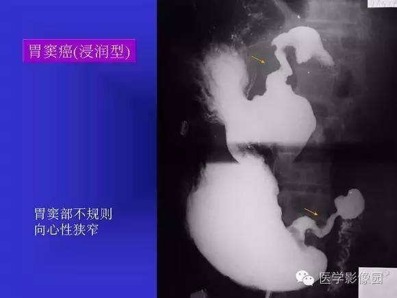【PPT】上消化道溃疡与胃癌的影像学表现