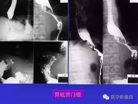 【PPT】上消化道溃疡与胃癌的影像学表现
