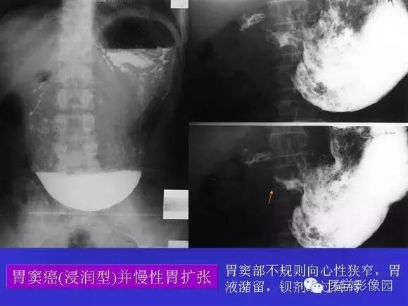 【PPT】上消化道溃疡与胃癌的影像学表现