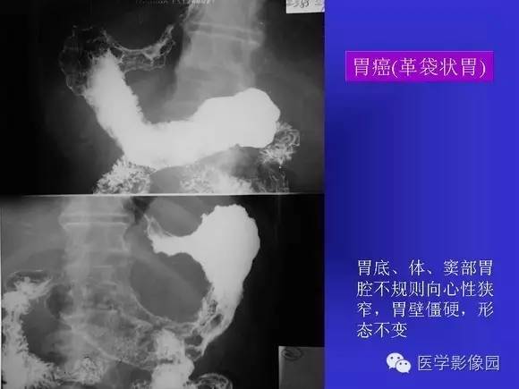 【PPT】上消化道溃疡与胃癌的影像学表现