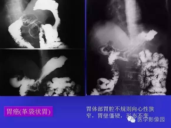 【PPT】上消化道溃疡与胃癌的影像学表现