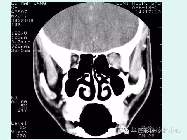 【病例】视神经胶质瘤1例CT影像表现