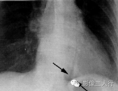 "Naclerio “V” 征"，这个征象提示啥？