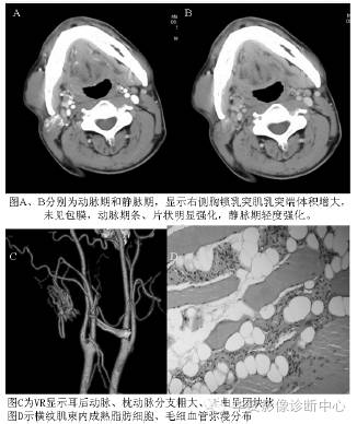 【病例】颈部血管脂肪瘤1例CT影像表现