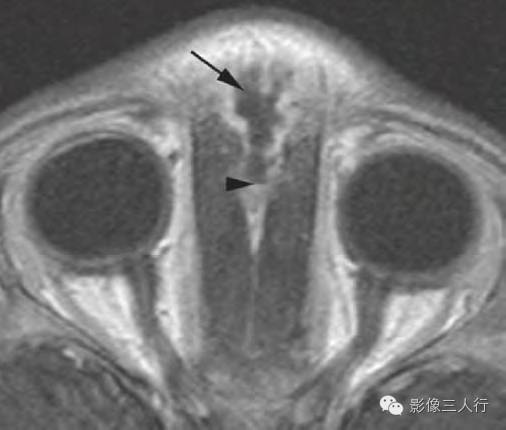 【病例】鼻部皮样囊肿合并感染1例MR影像表现分析