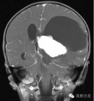 【病例】侧脑室室管膜瘤1例MR影像表现