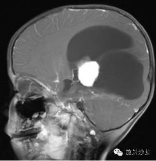 【病例】侧脑室室管膜瘤1例MR影像表现