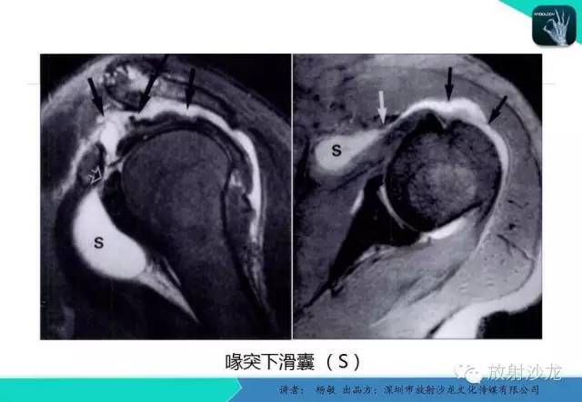 【PPT】滑囊