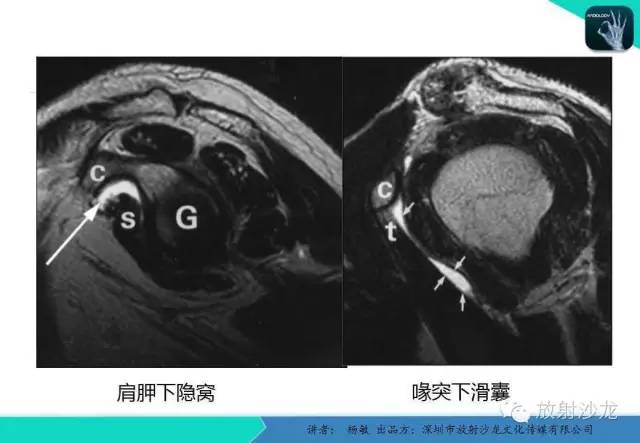 【PPT】滑囊