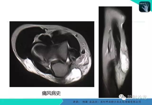 【PPT】滑囊