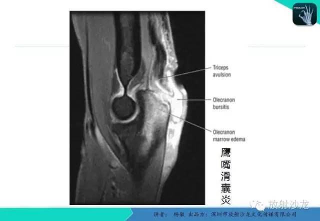 【PPT】滑囊