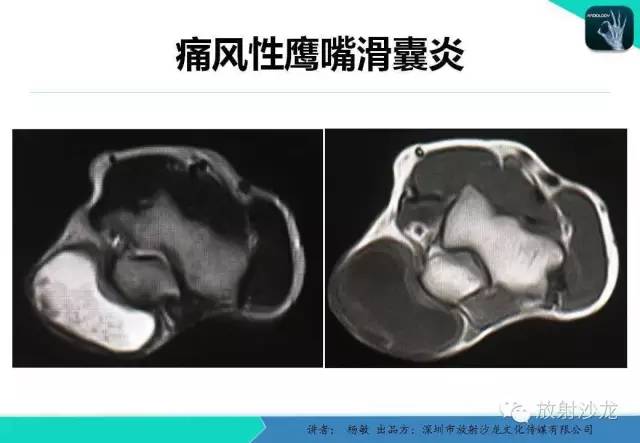 【PPT】滑囊
