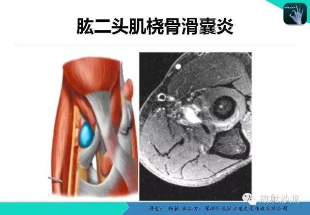 【PPT】滑囊