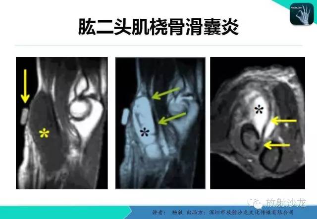 【PPT】滑囊