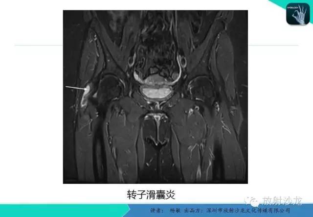 【PPT】滑囊