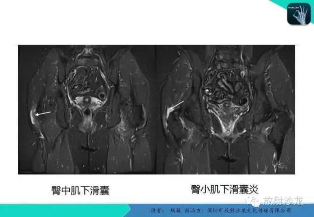 【PPT】滑囊